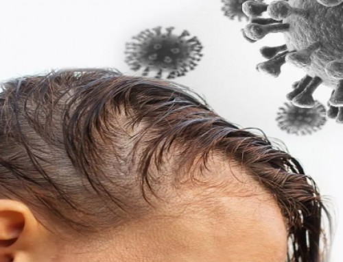  Wypadanie włosów po COVID 19 – jak leczyć?